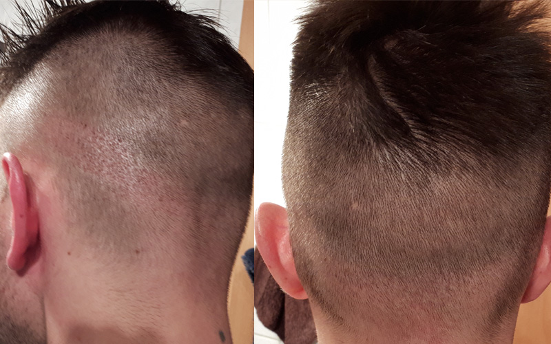 Fue Haartransplantation In Prag Tschechien ᐅ Erfahrung Verlauf